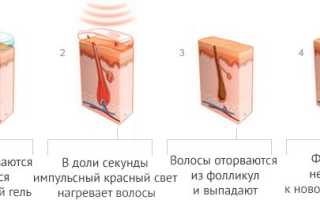 Все способы удаления волос на лице и теле: какой выбрать?