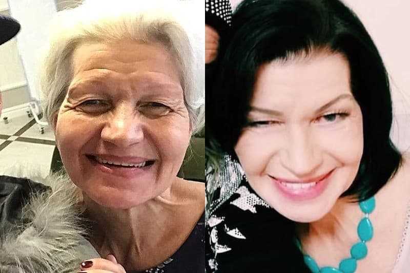 Екатерина Терешкович до и после пластики