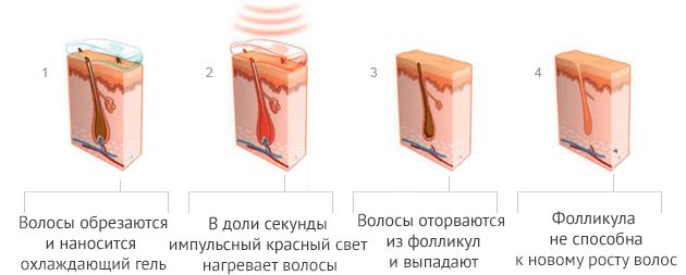 Лазерное удаление волос навсегда